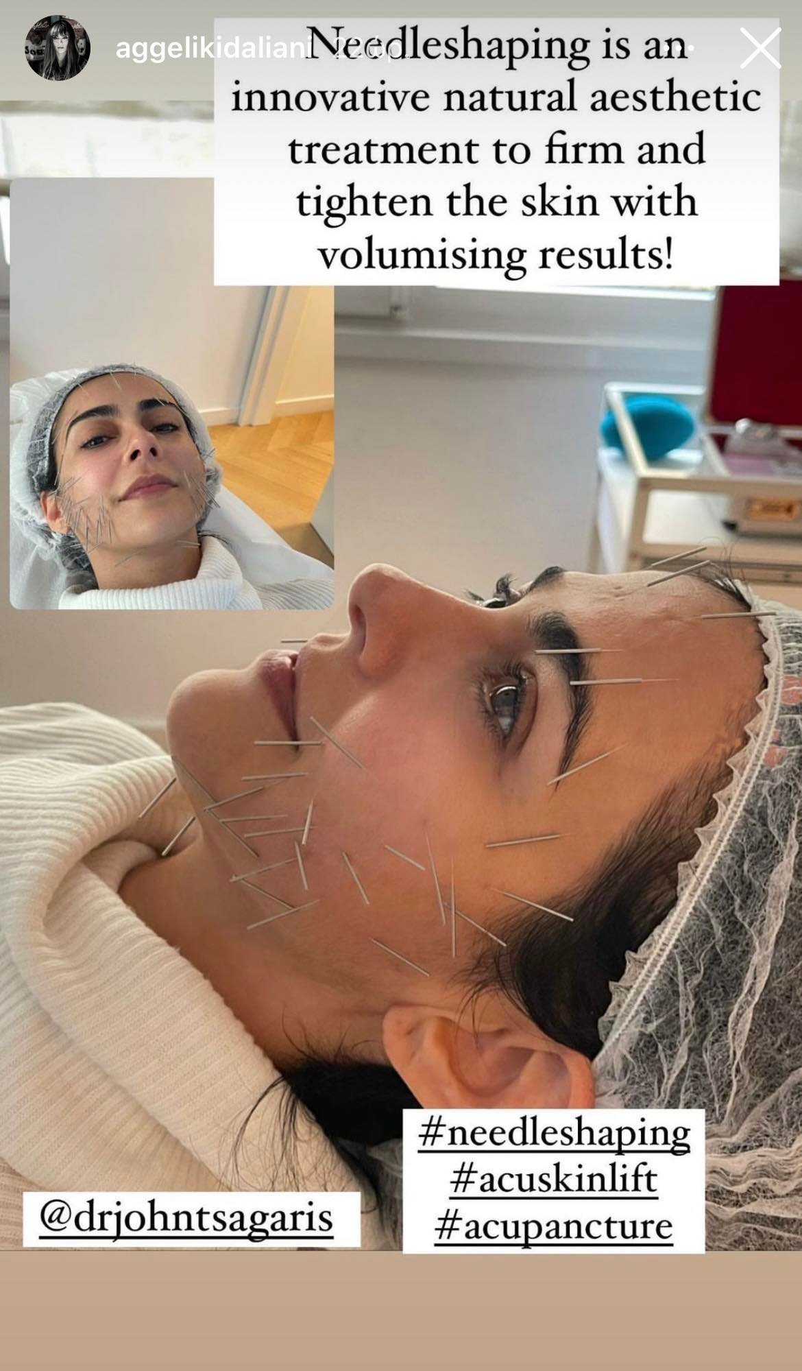 Αγγελική Δαλιάνη: Έκανε βελονισμό στο πρόσωπό της- Γιατί η θεραπεία αυτή θεωρείται καλύτερη από το botox;